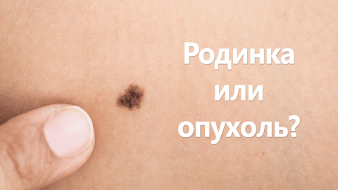 Подозреваете меланому - сразу к врачу!