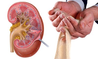 Песок в почках: начинаем лечение вовремя